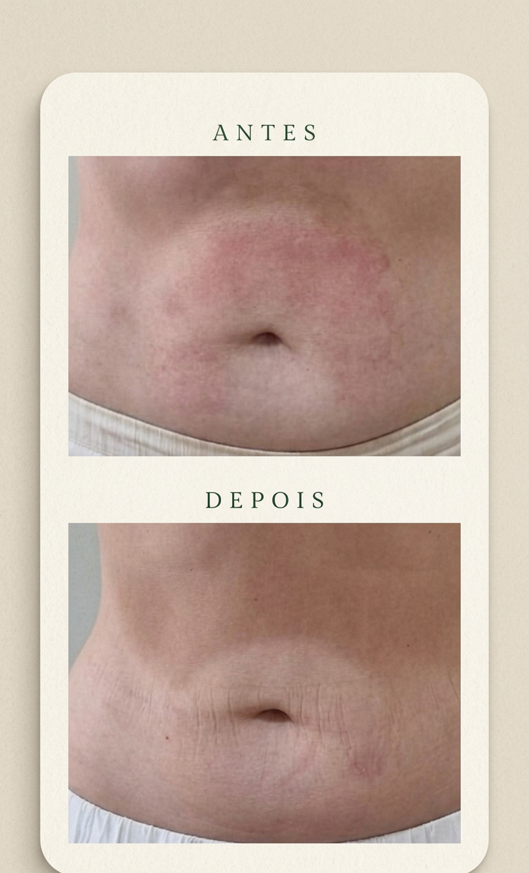 Antes e depois de flacidez abdominal na Clínica Change